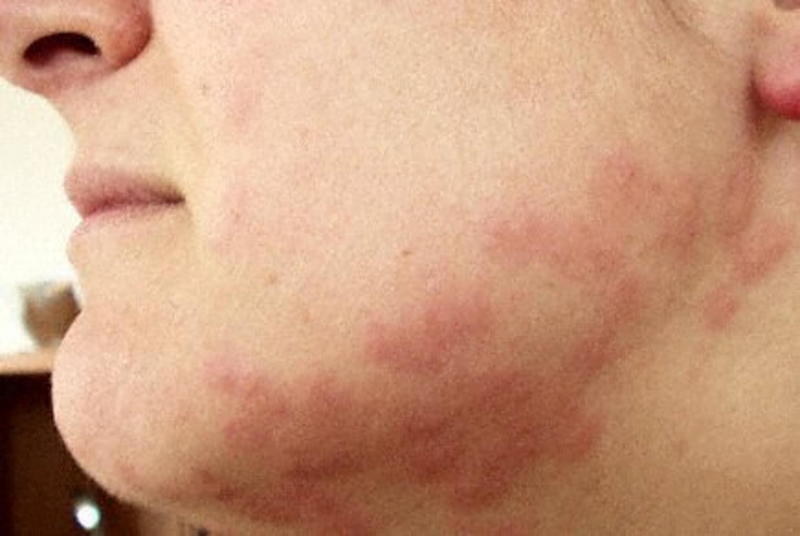 Bedbug bite marks on woman neck and chin
